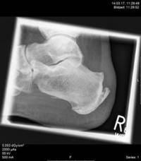 "Ein Röntgenbild mit sichtbarer Knochenausziehung am Fersenbein"