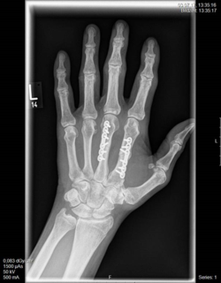 "Röntgenbild nach der OP der Mittelhandknochen"